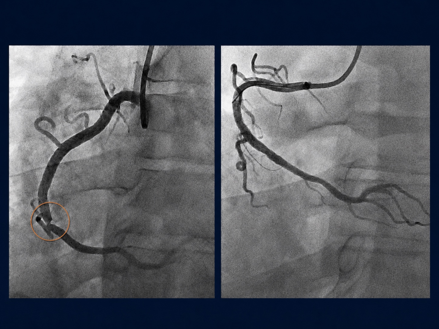 Coronary angiogram comparison: left panel shows severe narrowing limiting blood flow at the lesion site (marked with an orange circle); right panel shows the same coronary artery after stent placement, with restored vessel patency and improved blood flow.