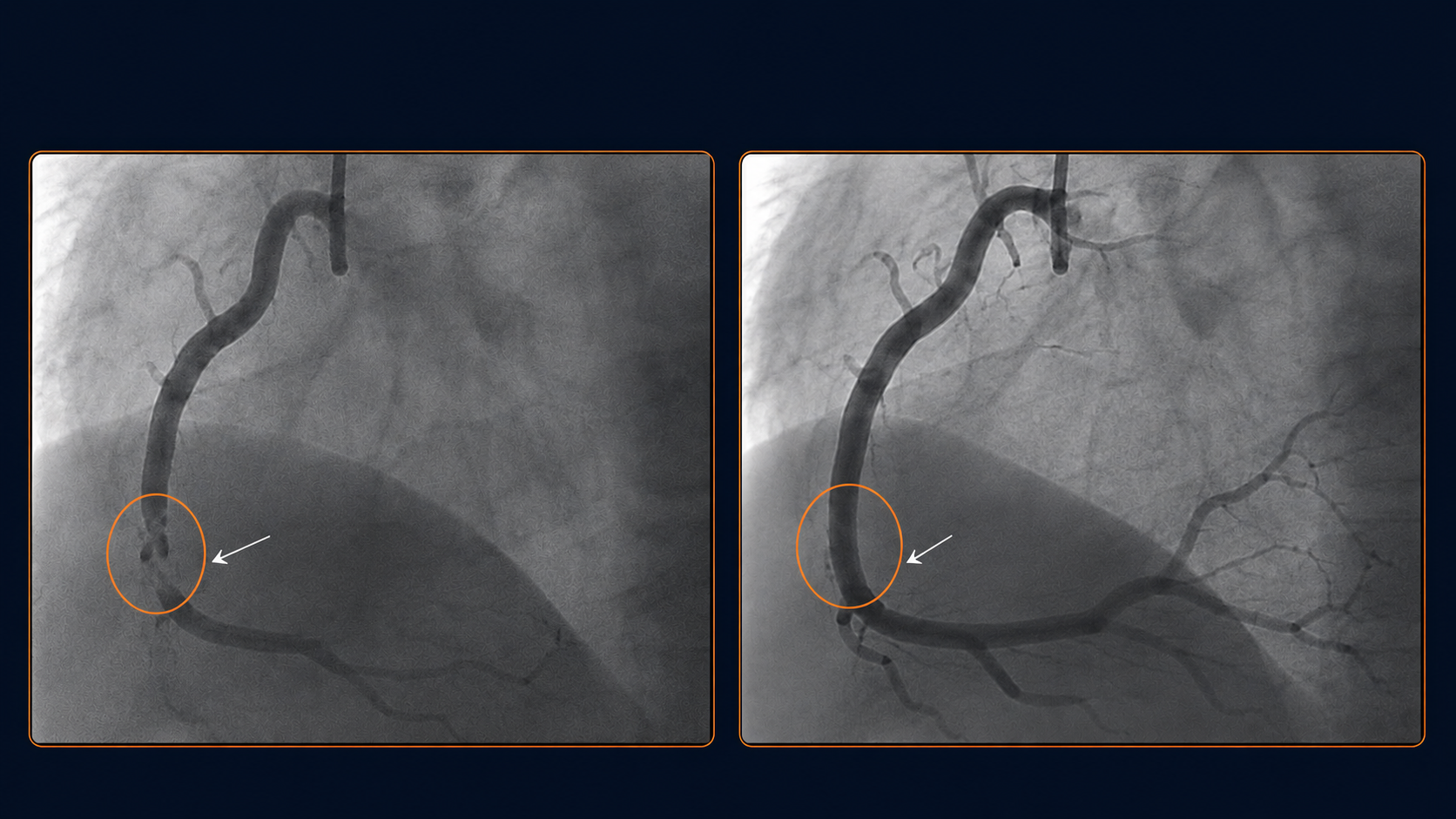 Coronary angiogram comparison: left panel shows severe narrowing limiting blood flow at the lesion site (orange circle); right panel shows the same artery after stent placement with restored vessel patency and improved blood flow (orange circle).